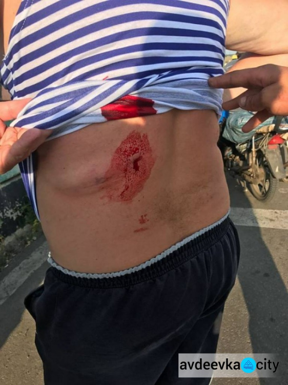Мужчина получил пулю в спину в районе КПВВ "Марьинка" (ФОТО)