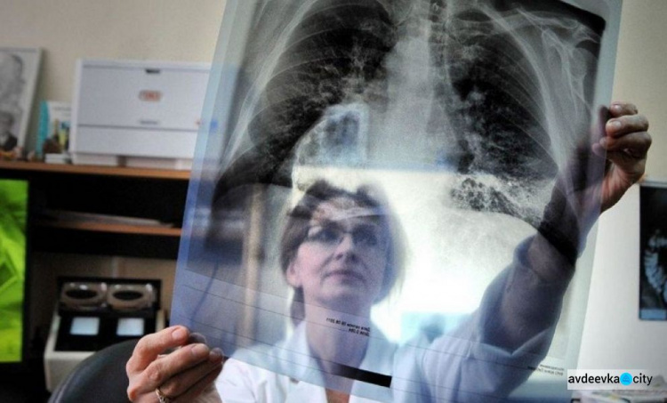 В Украине зарегистрировали инновационное лекарство от туберкулеза