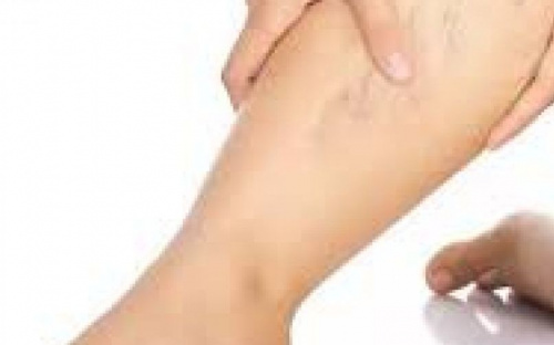 Авдіївцям до уваги: доктор Комаровський розповів, як не допустити варикоз